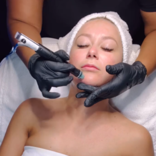 Diamond Tip Microdermabrasion